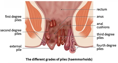 piles in ano